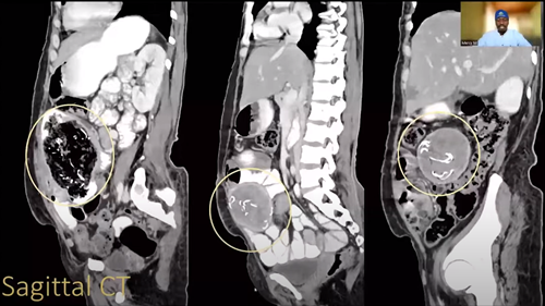  People’s choice award An unexpected cause of abdominal and back pain: three large gossypibomas related to remote surgery Daniel Moenga Kenya